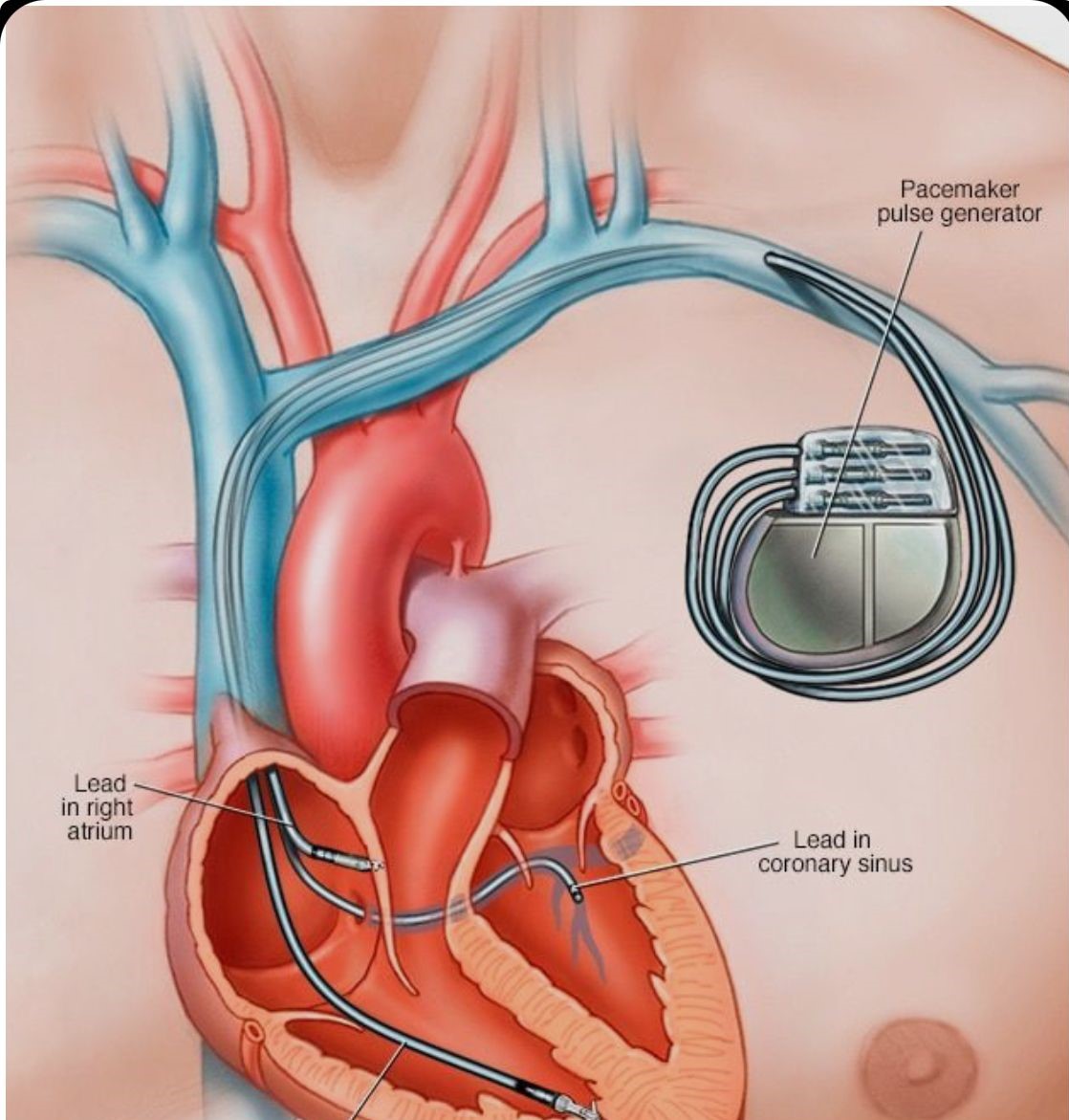 Cardiac Device Implantation