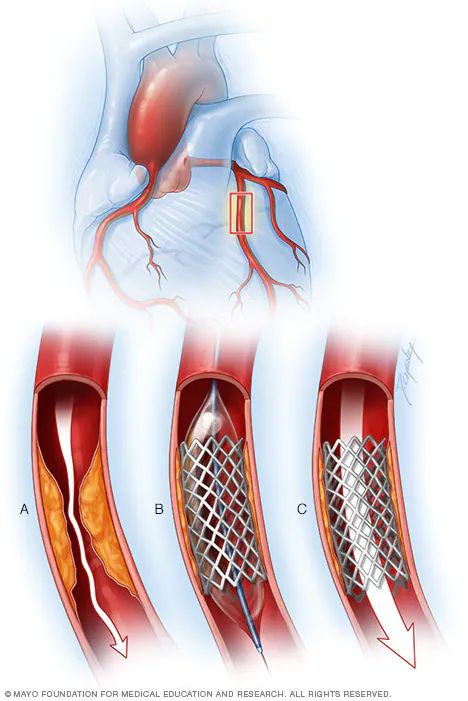 Coronary Angioplasty